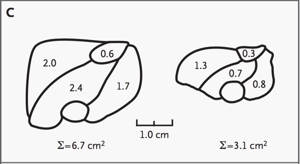 human myostatin deletion3